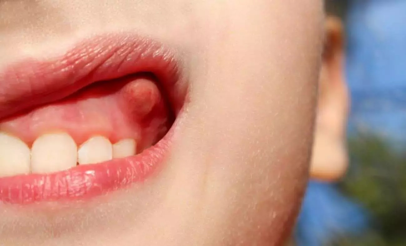 What is Tooth Infection and How is it Treated?