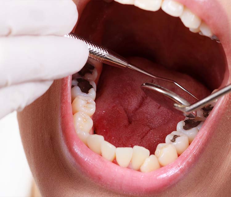 What is Tooth Decay and How Can It Be Prevented?