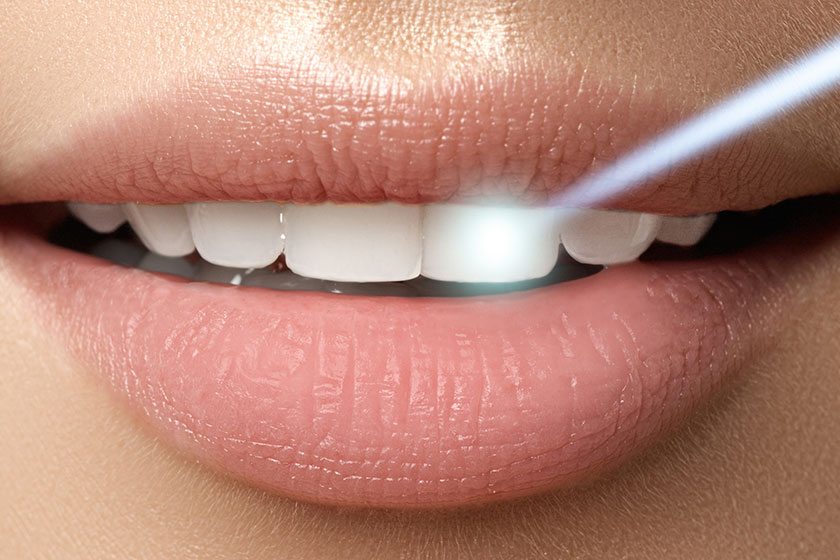 Teeth Whitening