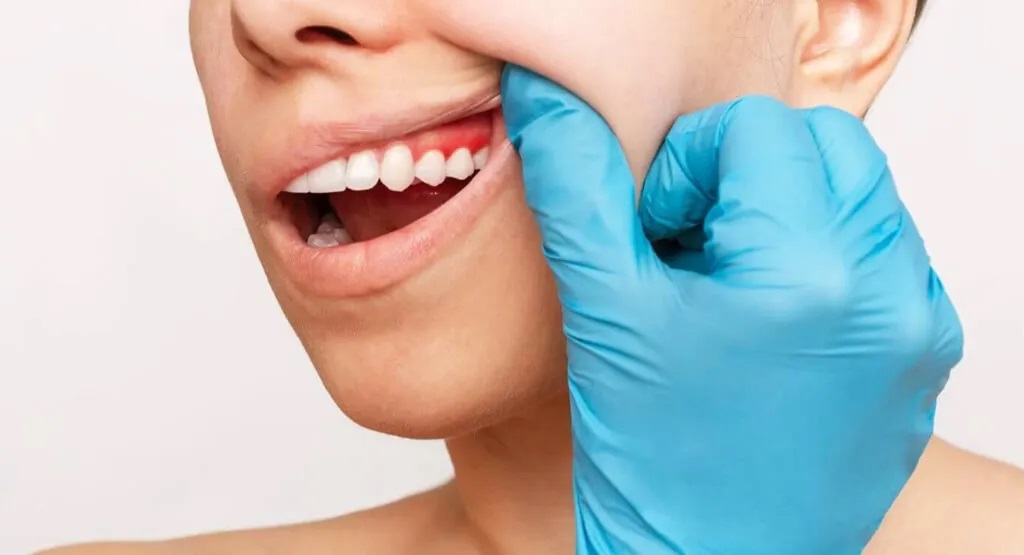 Gum Disease Treatment
